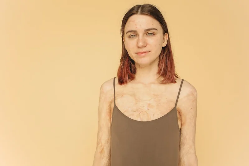 눈썹 탈색 후 화상 흉터 줄이는 법